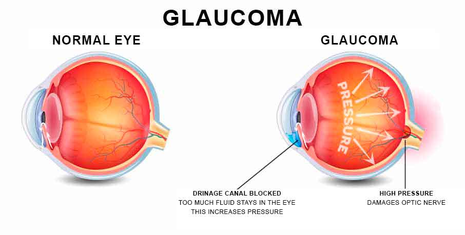 Glaucoma Cannabis