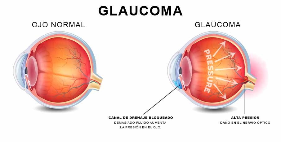 Glaucoma marihuana